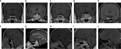 Case Report: Temozolomide Treatment of Refractory Prolactinoma Resistant to Dopamine Agonists